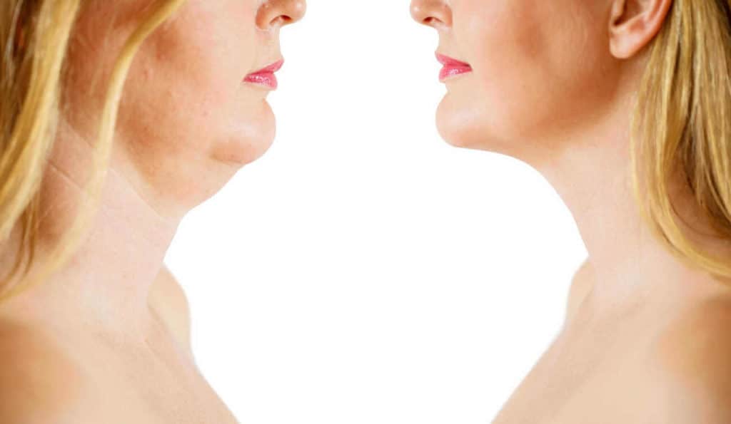Double Chin treatment Kingston upon Thames before and after results