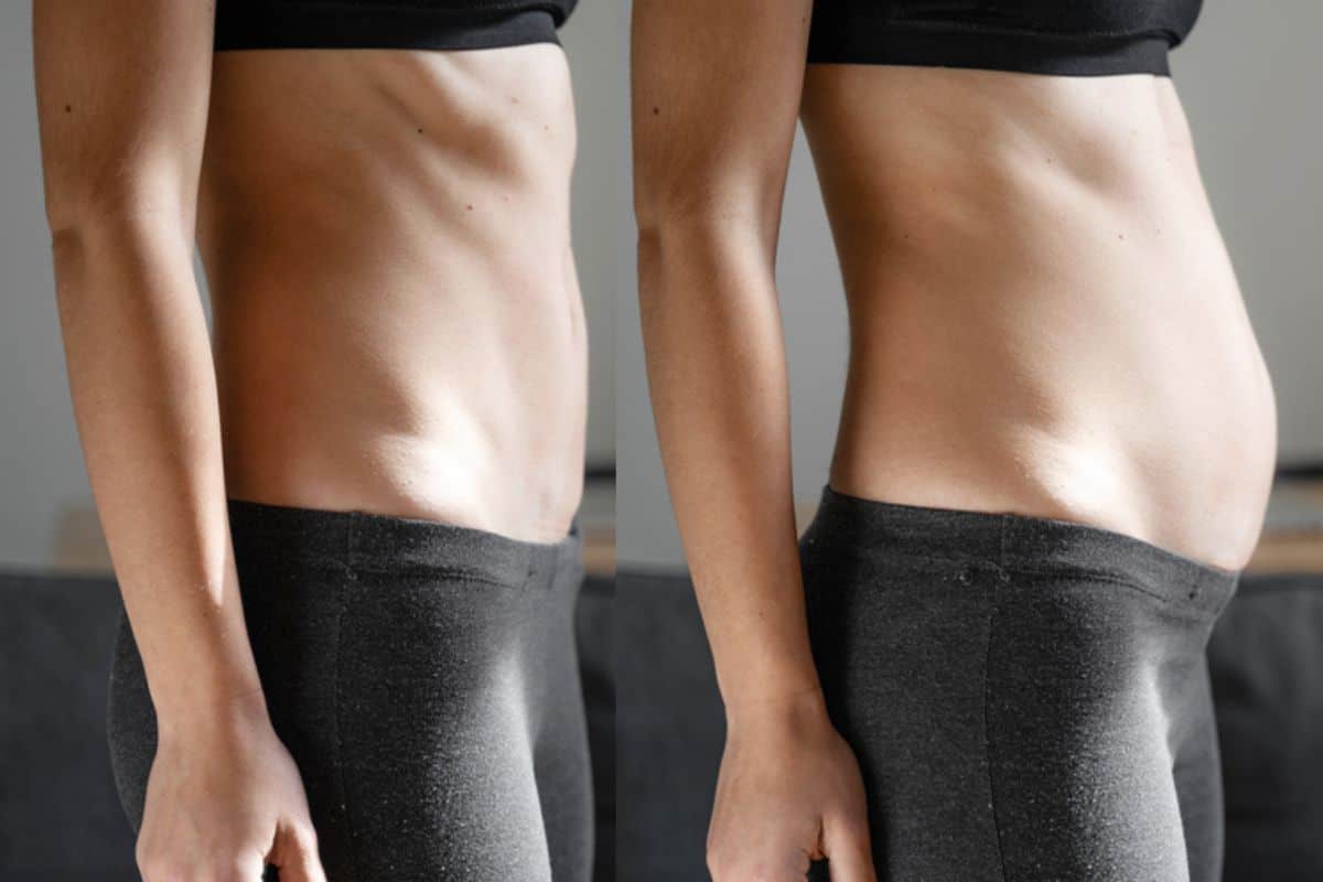 How long does diastasis recti take to improve Kingston upon Thames?