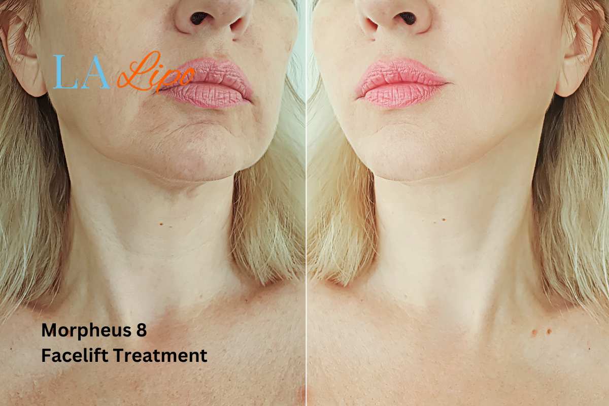 Turn back time with Morpheus8 Treatment Kingston upon Thames