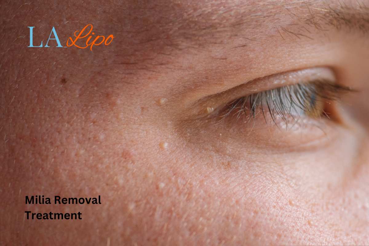 Cryopen Milia Removal: Is It the Easiest and Safest Option Kingston upon Thames?