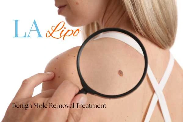Why getting moles removed Kingston upon Thames can boost your confidence!