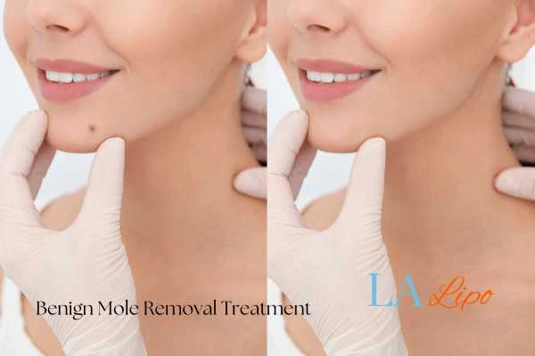 Woman's before and after results of being moles removal treatment Kingston upon Thames