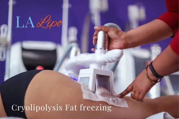 women getting fat freezing Kingston upon Thames