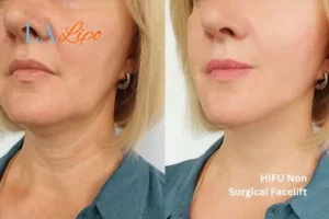hi-fu for wrinkles Kingston upon Thames before and after results