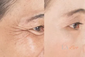 Before and after results of woman - HI-fu wrinkles reduction treatment Kingston upon Thames