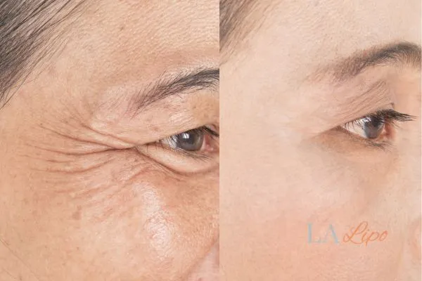Before and after results of woman - HI-fu wrinkles reduction treatment Kingston upon Thames