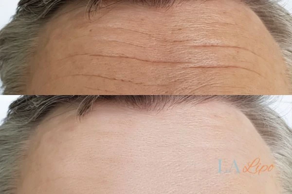 results of HIFU Kingston upon Thames on mans forehead to help reduce lines and wrinkles