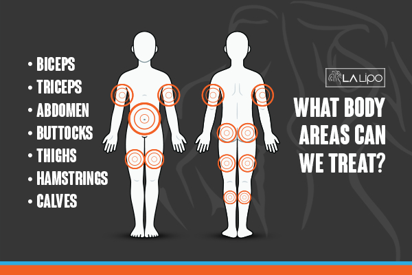 Graphic to show areas you can have LA-EMS Body Sculpting Kingston upon Thames treatment.