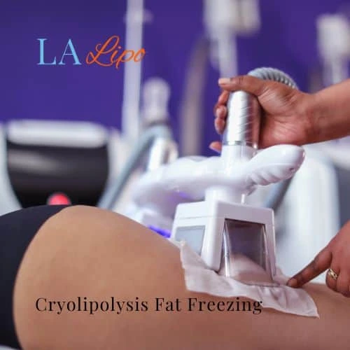 fat freezing - Cryolipolysis Kingston upon Thames