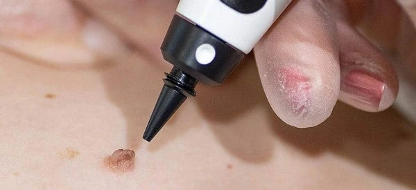 skin tag removal using cryopen Kingston upon Thames