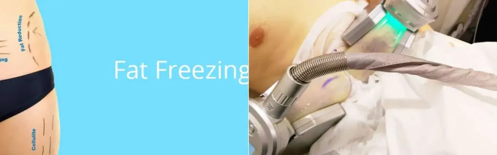 Fat freezing Kingston upon Thames on multiple areas of the body