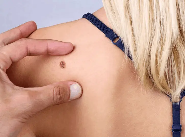 woman having mole removal Kingston upon Thames consultation before treatment.