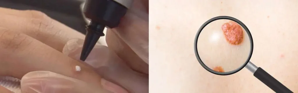 Cryopen for mole removal Kingston upon Thames - speak to our team today!