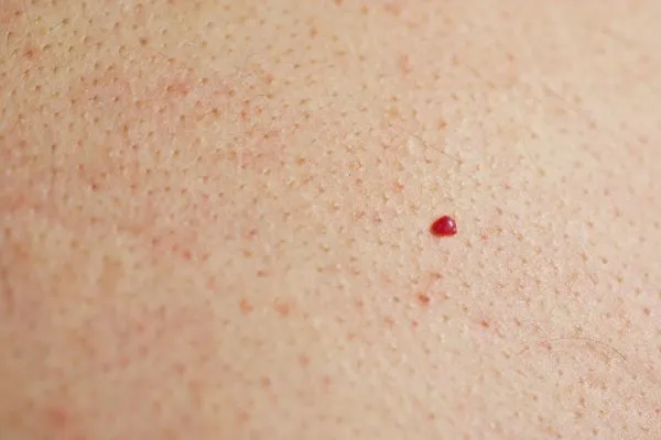 close up of a cherry angioma Kingston upon Thames