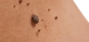 image of a skin tag Kingston upon Thames