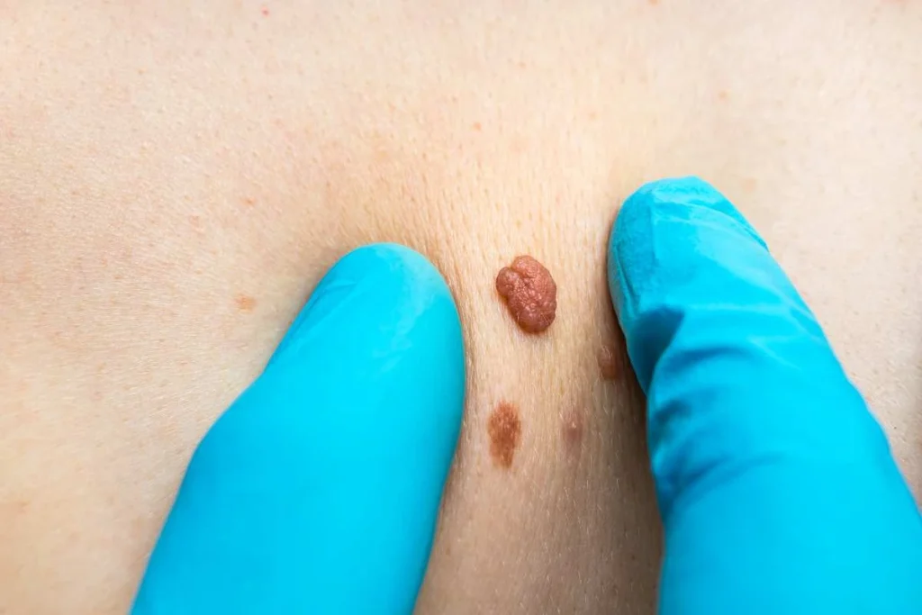 Consultant examining a skin tag Kingston upon Thames