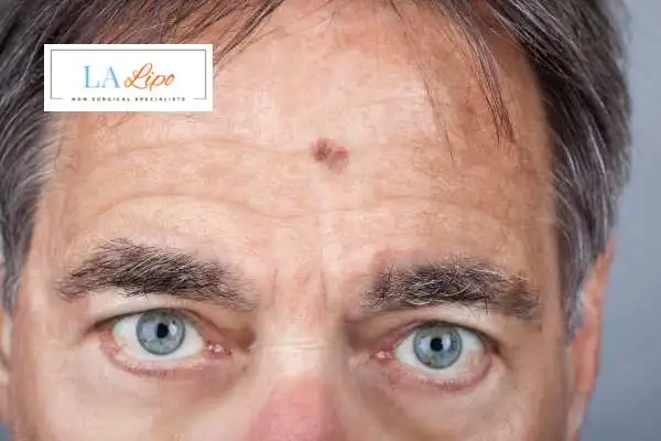 Solar Lentigo Removal Kingston upon Thames image of man with mark on his forehead