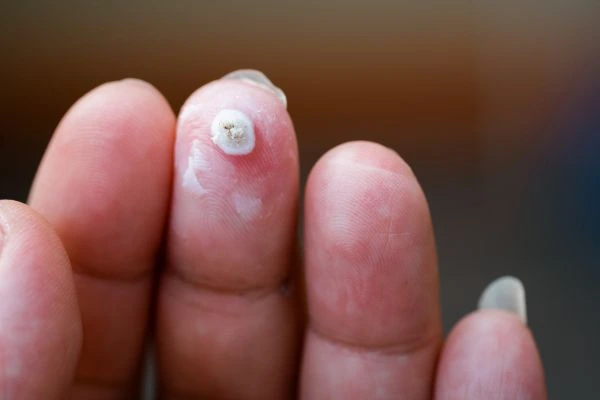 wart on person finger - cryotherapy to treat from LA LIPO Kingston upon Thames