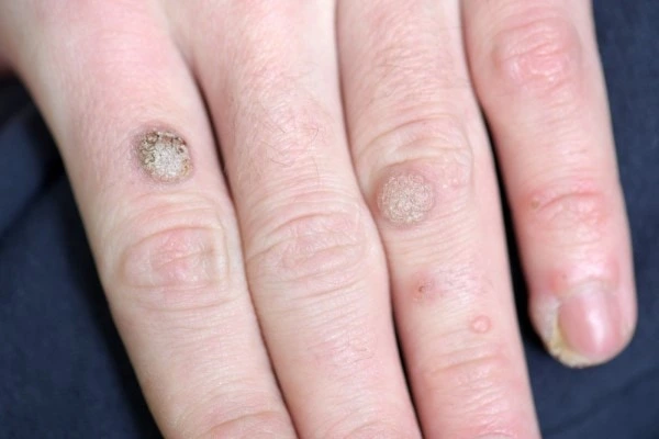 photo of warts on person hand - see wart removal Kingston upon Thames from LA LIPO