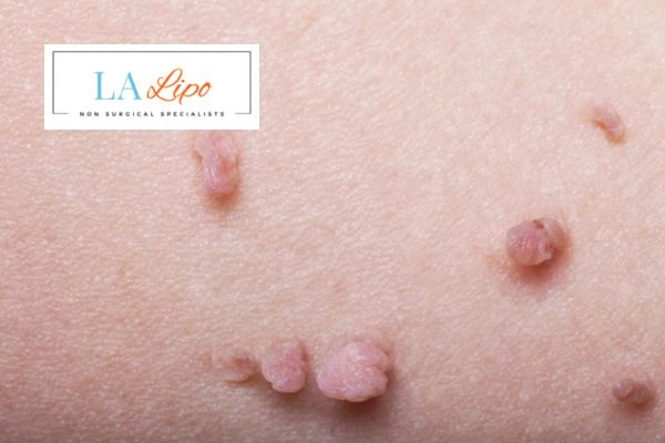 Does cryopen skin tag removal Kingston upon Thames hurt? Find out now call our team today!