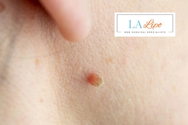Book skin tag removal Kingston upon Thames today speak to our team now!
