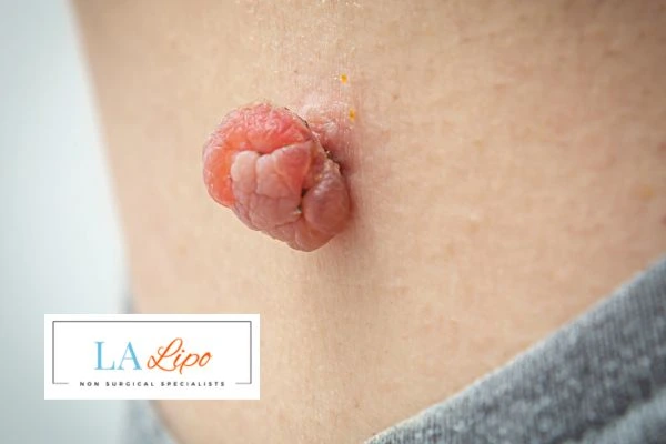 Interested in skin tag removal Kingston upon Thames? Concerned about the pain? Find out more today!