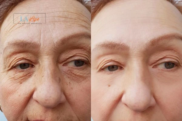 The powerful benefits of Morpheus8 Treatment Kingston upon Thames - Call Our team today!