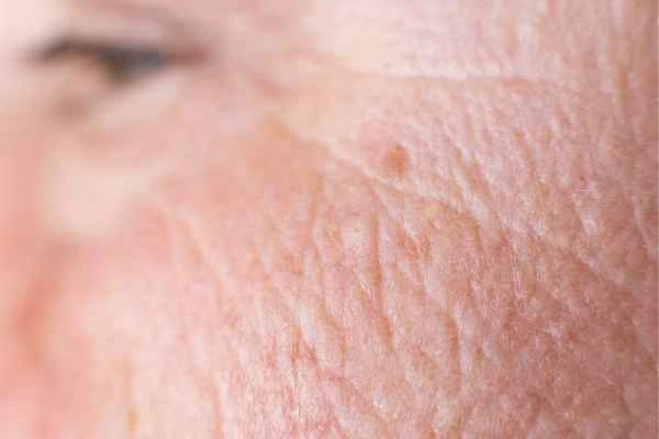 close up picture of a woman's face showing an age spot Kingston upon Thames