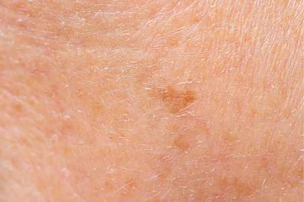 close up picture of age spots Kingston upon Thames