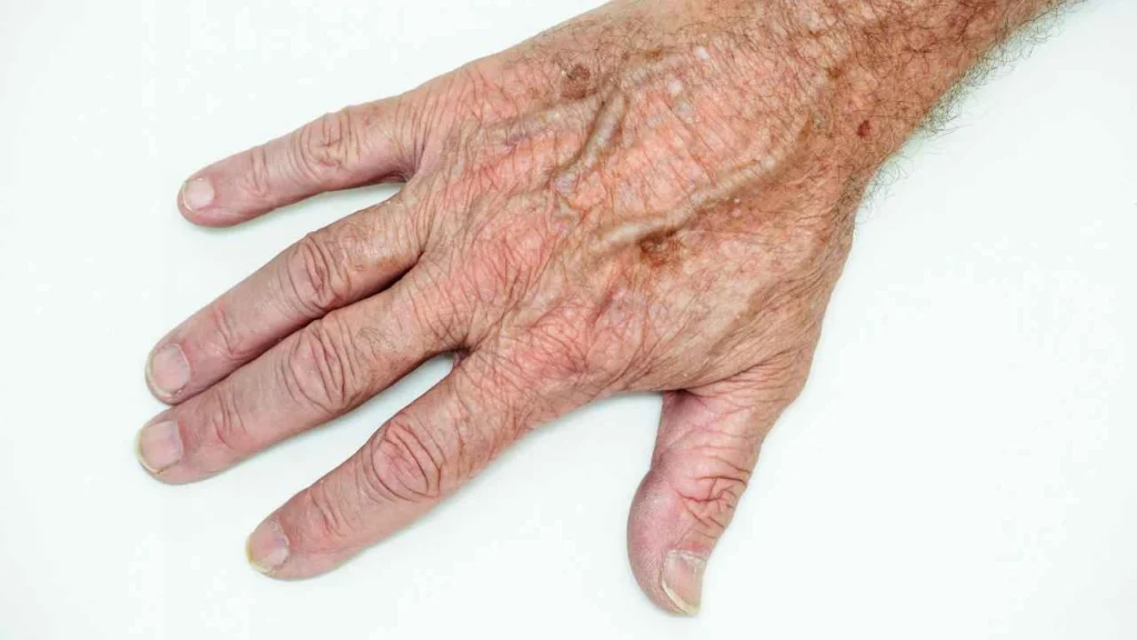 Male hand showing age spot Kingston upon Thames