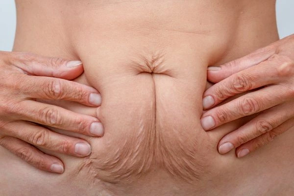 Image of a woman's stomach with loose skin - example of skin tightening Kingston upon Thames options