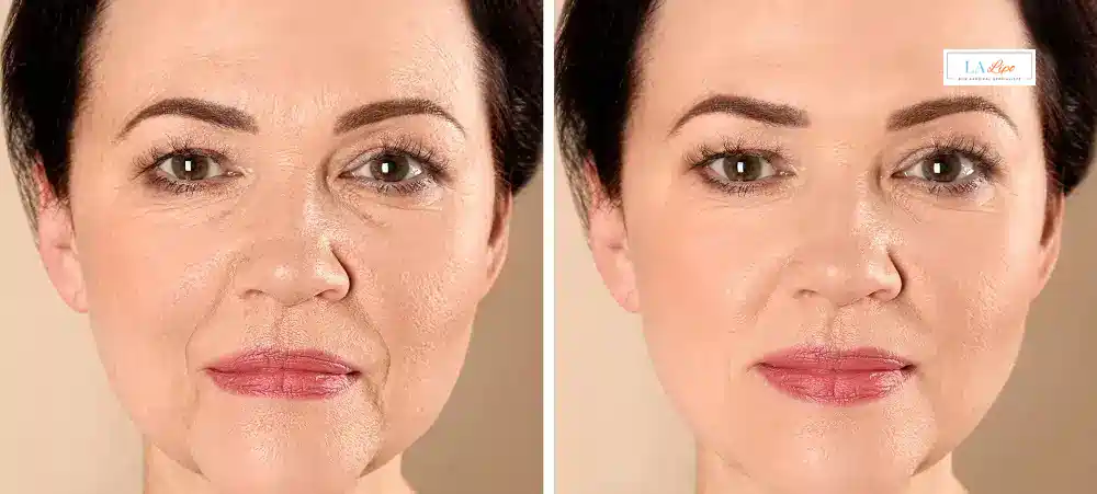 How Long Does It Take to See Results and How Long Do They Last Kingston upon Thames?