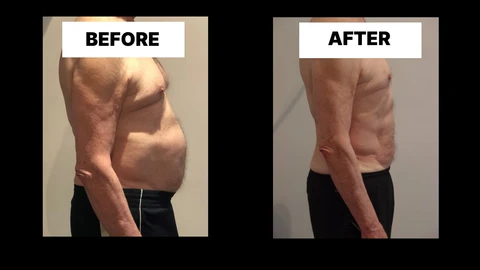 What Symptoms Can Diastasis Recti Cause in Men? Weak Core, Back Pain and Poor Posture Kingston upon Thames